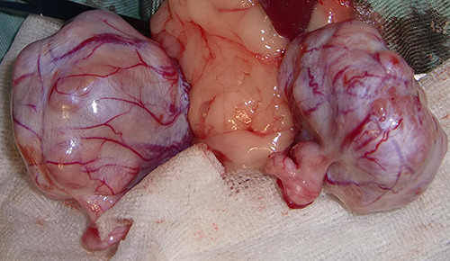 腹腔内陰睾の精巣腫瘍